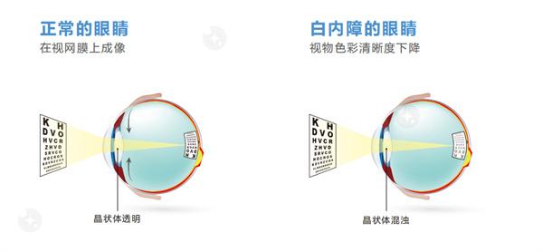 来看看宁波三焦点人工晶体费用多少钱，宁波三焦点人工晶体给力价格