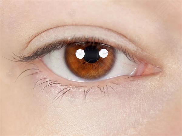 曝光菏泽非散光晶体植入ICL近视眼手术收费贵吗，菏泽非散光晶体植入ICL近视眼手术给力价格