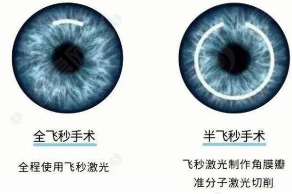飞秒手术