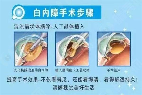 深圳眼科医院白内障手术价格表