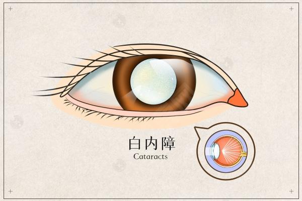 白内障 白内障