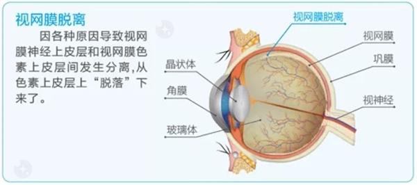 如何在不接受手术的情况下复原近视？