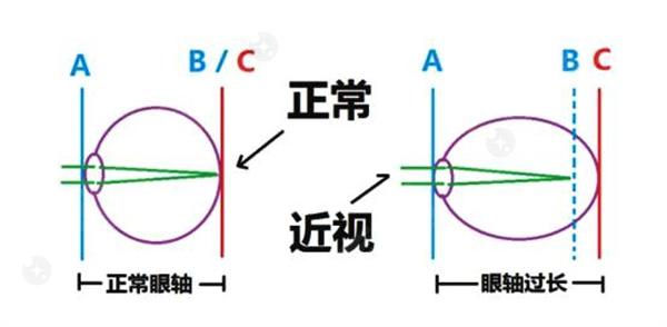 我患有斜视，为何无法参军入伍？对此有何矫正方法和科学依据？