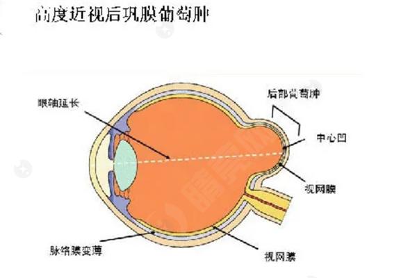 国内能做后巩膜加固术的医院有几家?分享正规可靠且好预约的口碑眼科医院