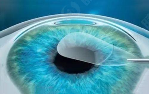 深圳爱尔眼科医院收费标准：一文说清近视手术全飞秒半飞秒晶体植入价格多少钱，让你心中有数！