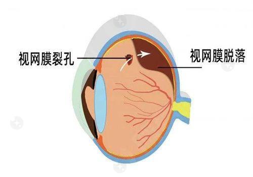 北京熙仁眼科医院封康医生后巩膜加固术优势