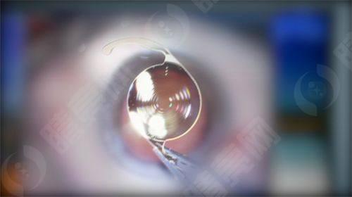 西安医大眼科医院手术优势及医生团队