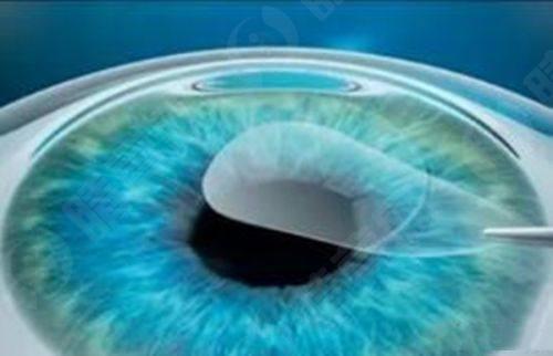 贵阳佰视佳眼科医院其他项目收费标准